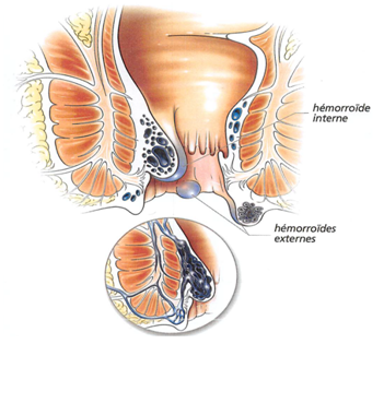 La Maladie Hémorroïdaire – Hémorroïdes Lyon