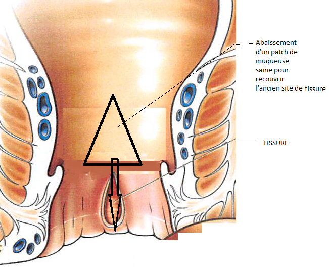 La fissure anale – Hémorroïdes Lyon