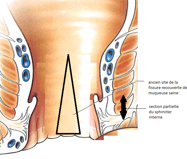 La fissure anale – Hémorroïdes Lyon