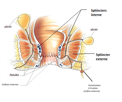 La fistule anale – Hémorroïdes Lyon